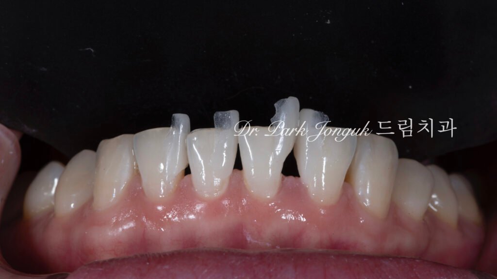 no-prep veneers, minimal prep veneers, porcelain veneers, biomimetic dentistry, cosmetic dentistry, aesthetic dentistry, non invasive dentistry, 무삭제 라미네이트, 라미네이트, 앞니 라미네이트, 벌어진 치아 라미네이트, 왜소치 라미네이트, diastema veneers, microdontia veneers, natural veneers, hand layered veneers, 강남 라미네이트