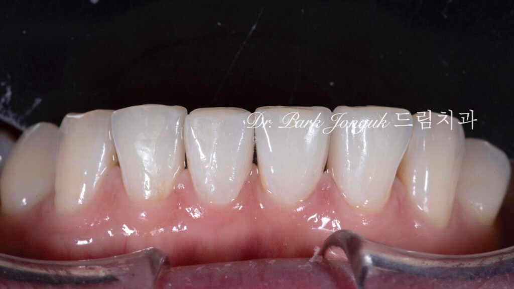 no-prep veneers, minimal prep veneers, porcelain veneers, biomimetic dentistry, cosmetic dentistry, aesthetic dentistry, non invasive dentistry, 무삭제 라미네이트, 라미네이트, 앞니 라미네이트, 벌어진 치아 라미네이트, 왜소치 라미네이트, diastema veneers, microdontia veneers, natural veneers, hand layered veneers, 강남 라미네이트