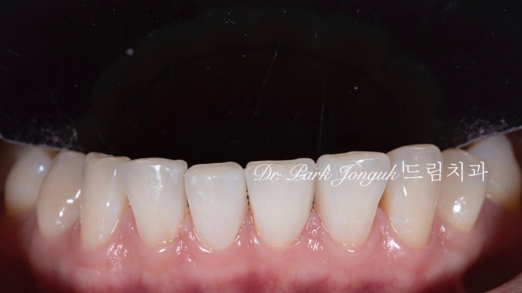 no-prep veneers, minimal prep veneers, porcelain veneers, biomimetic dentistry, cosmetic dentistry, aesthetic dentistry, non invasive dentistry, 무삭제 라미네이트, 라미네이트, 앞니 라미네이트, 벌어진 치아 라미네이트, 왜소치 라미네이트, diastema veneers, microdontia veneers, natural veneers, hand layered veneers, 강남 라미네이트