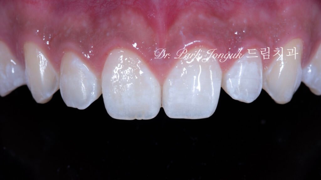 무삭제 라미네이트, No-Prep Laminate, 무삭제, No-Preparation, 치아 안 깎는 라미네이트, Non-Invasive Laminate, 옥니 라미네이트, Retroclined Teeth Laminate, 왜소치, Microdontia, 수작업 빌드업, Hand-Layered Build-up