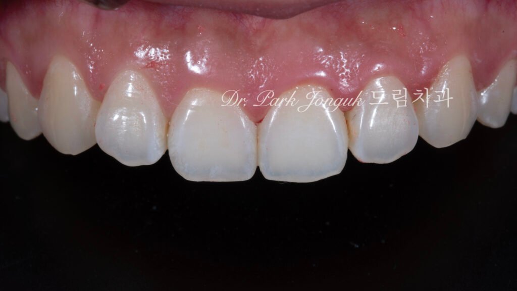 무삭제 라미네이트, No-Prep Laminate, 옥니 라미네이트, Laminate for Retroclined Teeth, 작은 치아, Small Teeth, 비교정 무삭제, Non-Orthodontic No-Prep, 수작업 빌드업, Hand-Layered Build-up, 초박형 라미네이트, Ultra-Thin Laminate