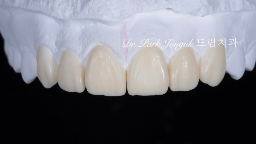 무삭제 라미네이트, No-Prep Laminate, 무삭제, No-Preparation, 치아 안 깎는 라미네이트, Non-Invasive Laminate, 옥니 라미네이트, Retroclined Teeth Laminate, 왜소치, Microdontia, 수작업 빌드업, Hand-Layered Build-up