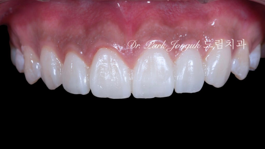 무삭제 라미네이트, No-Prep Laminate, 무삭제, No-Preparation, 치아 안 깎는 라미네이트, Non-Invasive Laminate, 옥니 라미네이트, Retroclined Teeth Laminate, 왜소치, Microdontia, 수작업 빌드업, Hand-Layered Build-up