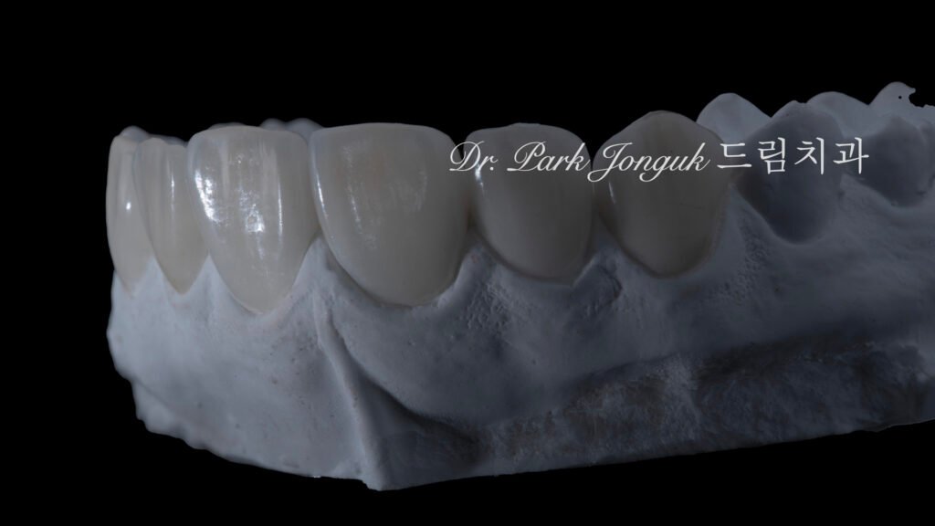 무삭제 라미네이트, No-Prep Laminate, 무삭제, No-Preparation, 치아 안 깎는 라미네이트, Non-Invasive Laminate, 옥니 라미네이트, Retroclined Teeth Laminate, 왜소치, Microdontia, 수작업 빌드업, Hand-Layered Build-up