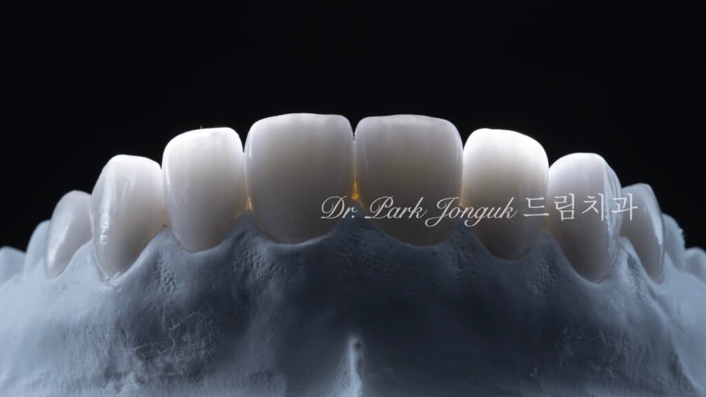 무삭제 라미네이트, No-Prep Laminate, 옥니 라미네이트, Laminate for Retroclined Teeth, 작은 치아, Small Teeth, 비교정 무삭제, Non-Orthodontic No-Prep, 수작업 빌드업, Hand-Layered Build-up, 초박형 라미네이트, Ultra-Thin Laminate