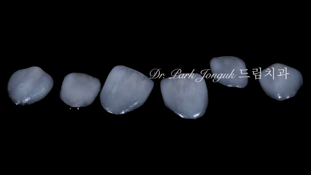 무삭제 라미네이트, No-Prep Laminate, 무삭제, No-Preparation, 치아 안 깎는 라미네이트, Non-Invasive Laminate, 옥니 라미네이트, Retroclined Teeth Laminate, 왜소치, Microdontia, 수작업 빌드업, Hand-Layered Build-up