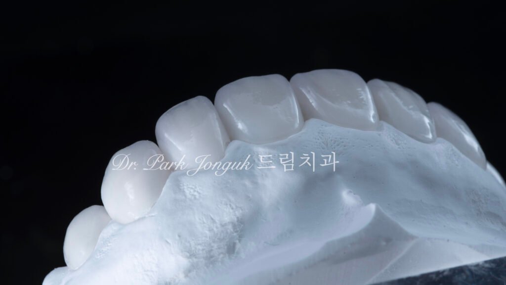 무삭제 라미네이트, No-Prep Laminate, 옥니 라미네이트, Laminate for Retroclined Teeth, 작은 치아, Small Teeth, 비교정 무삭제, Non-Orthodontic No-Prep, 수작업 빌드업, Hand-Layered Build-up, 초박형 라미네이트, Ultra-Thin Laminate