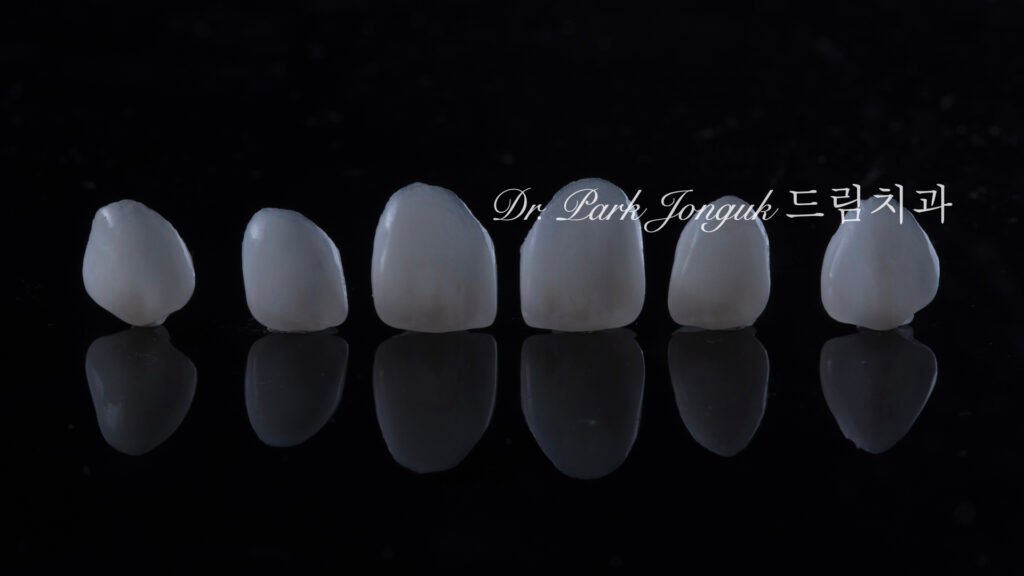 무삭제 라미네이트, No-Prep Laminate, 무삭제, No-Preparation, 치아 안 깎는 라미네이트, Non-Invasive Laminate, 옥니 라미네이트, Retroclined Teeth Laminate, 왜소치, Microdontia, 수작업 빌드업, Hand-Layered Build-up