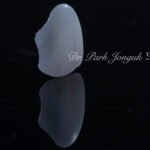 무삭제 라미네이트, No-Prep Laminate, 옥니 라미네이트, Laminate for Retroclined Teeth, 작은 치아, Small Teeth, 비교정 무삭제, Non-Orthodontic No-Prep, 수작업 빌드업, Hand-Layered Build-up, 초박형 라미네이트, Ultra-Thin Laminate