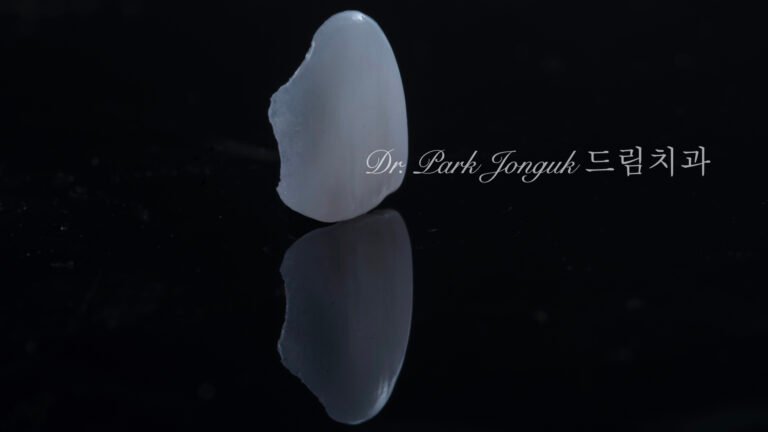 무삭제 라미네이트, No-Prep Laminate, 옥니 라미네이트, Laminate for Retroclined Teeth, 작은 치아, Small Teeth, 비교정 무삭제, Non-Orthodontic No-Prep, 수작업 빌드업, Hand-Layered Build-up, 초박형 라미네이트, Ultra-Thin Laminate