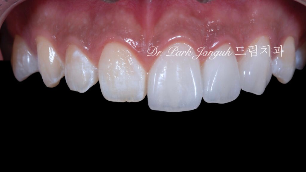 무삭제 라미네이트, No-Prep Laminate, 무삭제, No-Preparation, 치아 안 깎는 라미네이트, Non-Invasive Laminate, 옥니 라미네이트, Retroclined Teeth Laminate, 왜소치, Microdontia, 수작업 빌드업, Hand-Layered Build-up