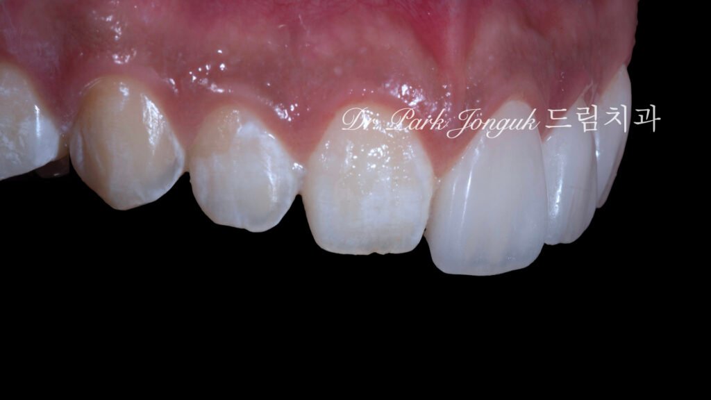 무삭제 라미네이트, No-Prep Laminate, 무삭제, No-Preparation, 치아 안 깎는 라미네이트, Non-Invasive Laminate, 옥니 라미네이트, Retroclined Teeth Laminate, 왜소치, Microdontia, 수작업 빌드업, Hand-Layered Build-up