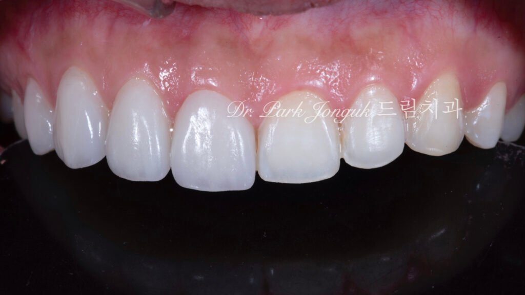 무삭제 라미네이트, No-Prep Laminate, 옥니 라미네이트, Laminate for Retroclined Teeth, 작은 치아, Small Teeth, 비교정 무삭제, Non-Orthodontic No-Prep, 수작업 빌드업, Hand-Layered Build-up, 초박형 라미네이트, Ultra-Thin Laminate