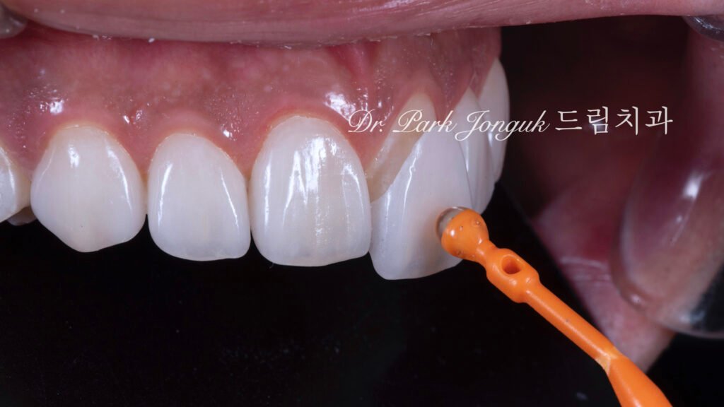 무삭제 라미네이트, No-Prep Laminate, 무삭제, No-Preparation, 치아 안 깎는 라미네이트, Non-Invasive Laminate, 옥니 라미네이트, Retroclined Teeth Laminate, 왜소치, Microdontia, 수작업 빌드업, Hand-Layered Build-up