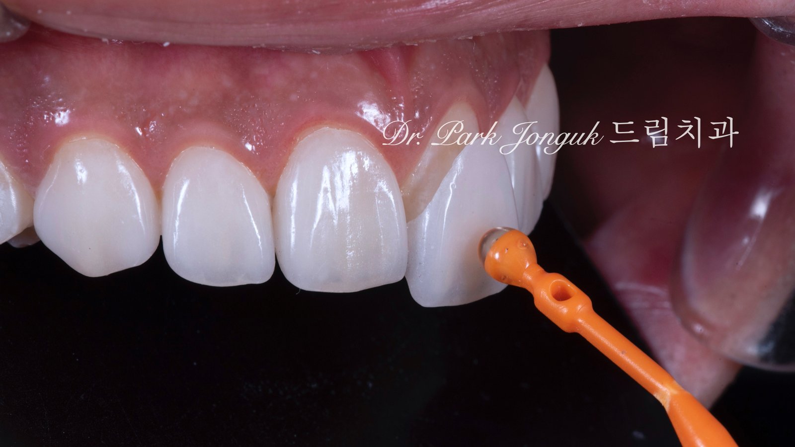 무삭제 라미네이트, No-Prep Laminate, 무삭제, No-Preparation, 치아 안 깎는 라미네이트, Non-Invasive Laminate, 옥니 라미네이트, Retroclined Teeth Laminate, 왜소치, Microdontia, 수작업 빌드업, Hand-Layered Build-up