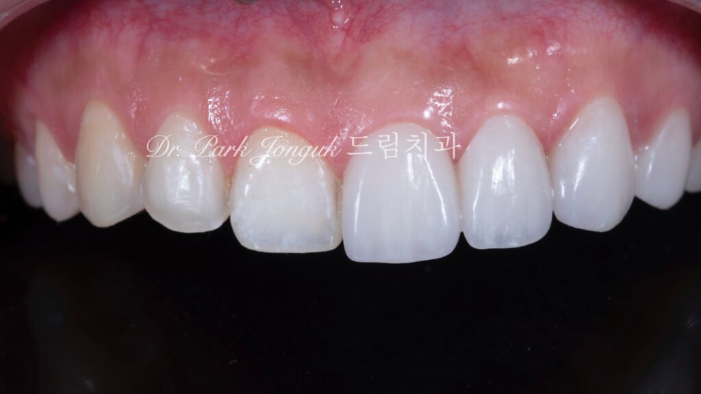 무삭제 라미네이트, No-Prep Laminate, 옥니 라미네이트, Laminate for Retroclined Teeth, 작은 치아, Small Teeth, 비교정 무삭제, Non-Orthodontic No-Prep, 수작업 빌드업, Hand-Layered Build-up, 초박형 라미네이트, Ultra-Thin Laminate