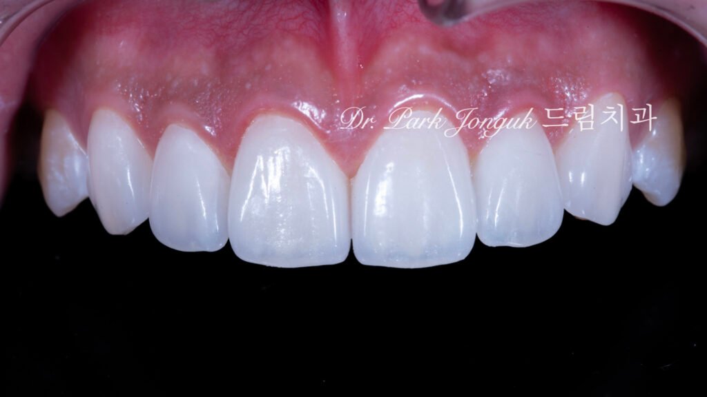 무삭제 라미네이트, No-Prep Laminate, 무삭제, No-Preparation, 치아 안 깎는 라미네이트, Non-Invasive Laminate, 옥니 라미네이트, Retroclined Teeth Laminate, 왜소치, Microdontia, 수작업 빌드업, Hand-Layered Build-up