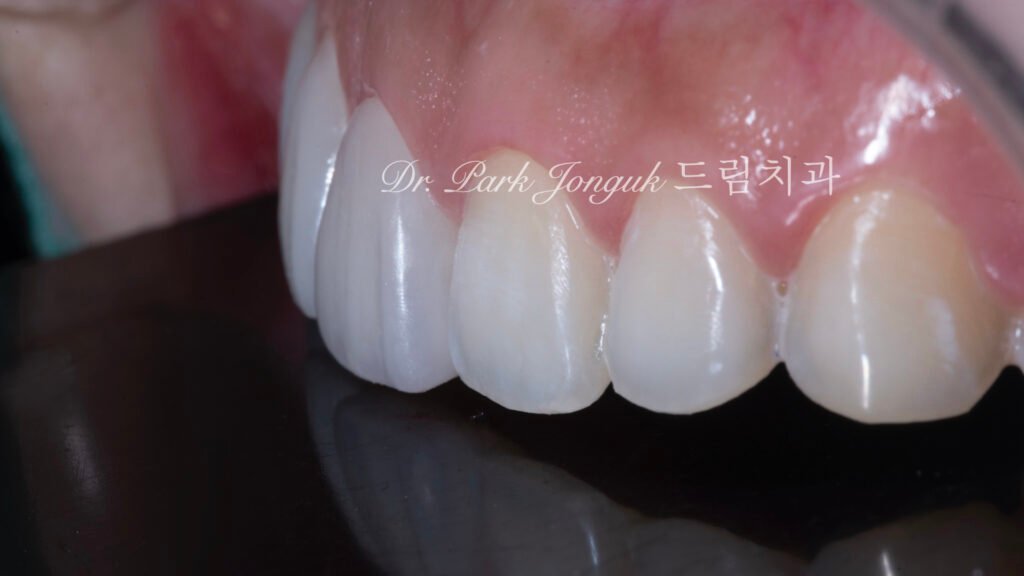 무삭제 라미네이트, No-Prep Laminate, 옥니 라미네이트, Laminate for Retroclined Teeth, 작은 치아, Small Teeth, 비교정 무삭제, Non-Orthodontic No-Prep, 수작업 빌드업, Hand-Layered Build-up, 초박형 라미네이트, Ultra-Thin Laminate