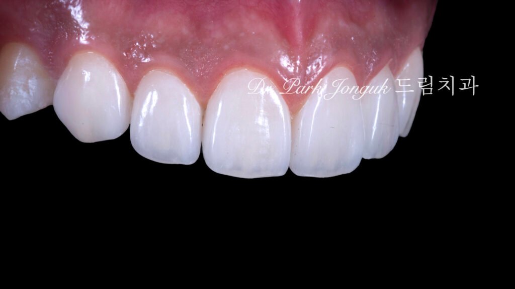 무삭제 라미네이트, No-Prep Laminate, 무삭제, No-Preparation, 치아 안 깎는 라미네이트, Non-Invasive Laminate, 옥니 라미네이트, Retroclined Teeth Laminate, 왜소치, Microdontia, 수작업 빌드업, Hand-Layered Build-up