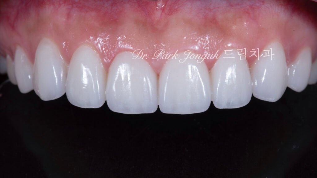 무삭제 라미네이트, No-Prep Laminate, 옥니 라미네이트, Laminate for Retroclined Teeth, 작은 치아, Small Teeth, 비교정 무삭제, Non-Orthodontic No-Prep, 수작업 빌드업, Hand-Layered Build-up, 초박형 라미네이트, Ultra-Thin Laminate