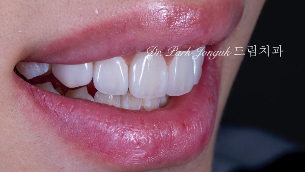 무삭제 라미네이트, No-Prep Laminate, 무삭제, No-Preparation, 치아 안 깎는 라미네이트, Non-Invasive Laminate, 옥니 라미네이트, Retroclined Teeth Laminate, 왜소치, Microdontia, 수작업 빌드업, Hand-Layered Build-up