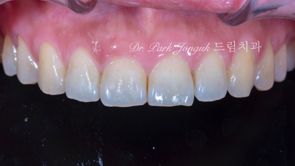 무삭제라미네이트, 교정후라미네이트, 치아스트리핑, IPR부작용, 앞니뻐드러짐, 보존과전문의, 박종욱원장, 압구정드림치과, 핸드메이드라미네이트, 치아심미복원, 왁스업진단, 최소삭제라미네이트