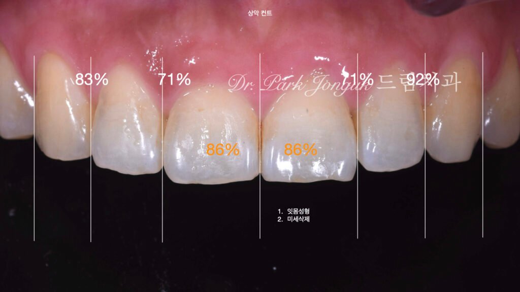 무삭제라미네이트, 교정후라미네이트, 치아스트리핑, IPR부작용, 앞니뻐드러짐, 보존과전문의, 박종욱원장, 압구정드림치과, 핸드메이드라미네이트, 치아심미복원, 왁스업진단, 최소삭제라미네이트