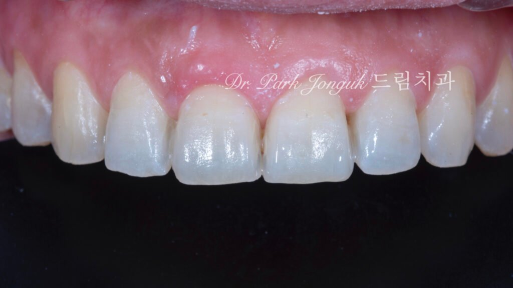 무삭제라미네이트, 교정후라미네이트, 치아스트리핑, IPR부작용, 앞니뻐드러짐, 보존과전문의, 박종욱원장, 압구정드림치과, 핸드메이드라미네이트, 치아심미복원, 왁스업진단, 최소삭제라미네이트