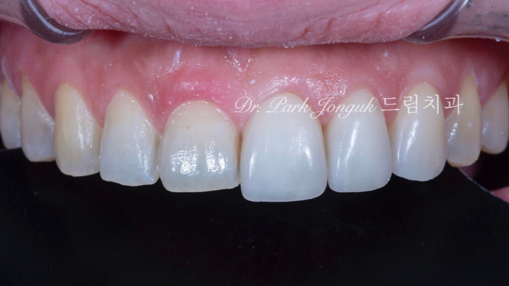 무삭제라미네이트, 교정후라미네이트, 치아스트리핑, IPR부작용, 앞니뻐드러짐, 보존과전문의, 박종욱원장, 압구정드림치과, 핸드메이드라미네이트, 치아심미복원, 왁스업진단, 최소삭제라미네이트