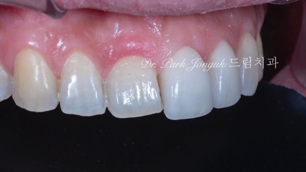 무삭제라미네이트, 교정후라미네이트, 치아스트리핑, IPR부작용, 앞니뻐드러짐, 보존과전문의, 박종욱원장, 압구정드림치과, 핸드메이드라미네이트, 치아심미복원, 왁스업진단, 최소삭제라미네이트