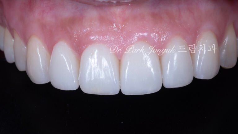 무삭제라미네이트, 교정후라미네이트, 치아스트리핑, IPR부작용, 앞니뻐드러짐, 보존과전문의, 박종욱원장, 압구정드림치과, 핸드메이드라미네이트, 치아심미복원, 왁스업진단, 최소삭제라미네이트