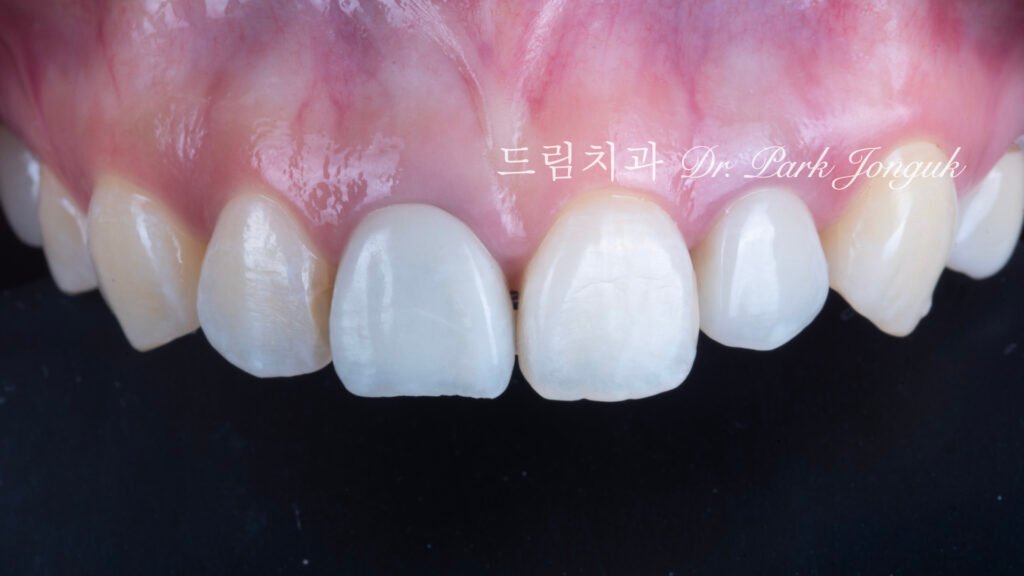 올세라믹 크라운 재시술, All-Ceramic Crown Revision, 라미네이트 재시술, Laminate Revision, 앞니 재치료, Anterior Revision, 실활치 미백, Internal Bleaching, 치은 착색, Gingival Discoloration, 지르코니아 크라운, Zirconia Crown