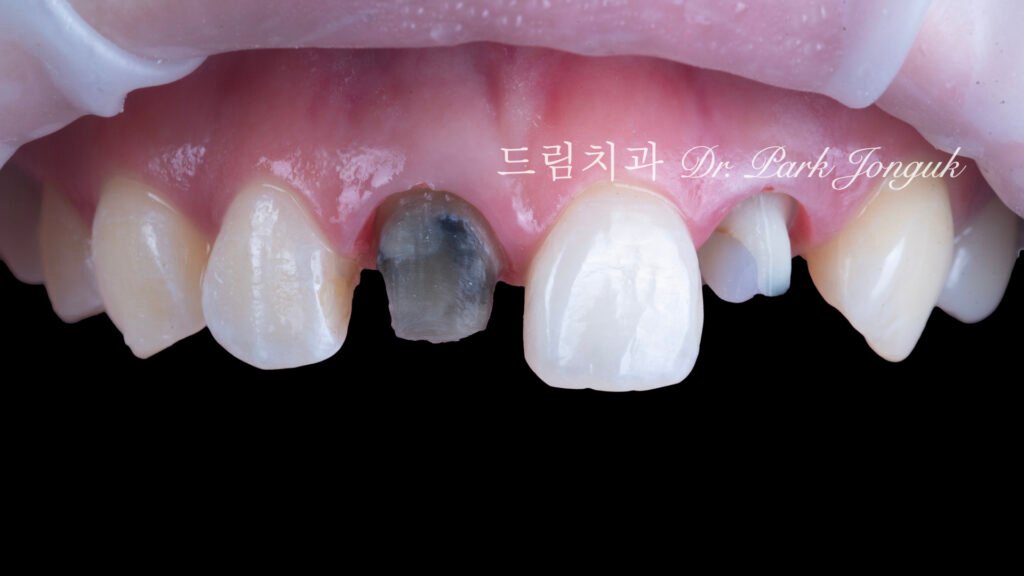 올세라믹 크라운 재시술, All-Ceramic Crown Revision, 라미네이트 재시술, Laminate Revision, 앞니 재치료, Anterior Revision, 실활치 미백, Internal Bleaching, 치은 착색, Gingival Discoloration, 지르코니아 크라운, Zirconia Crown