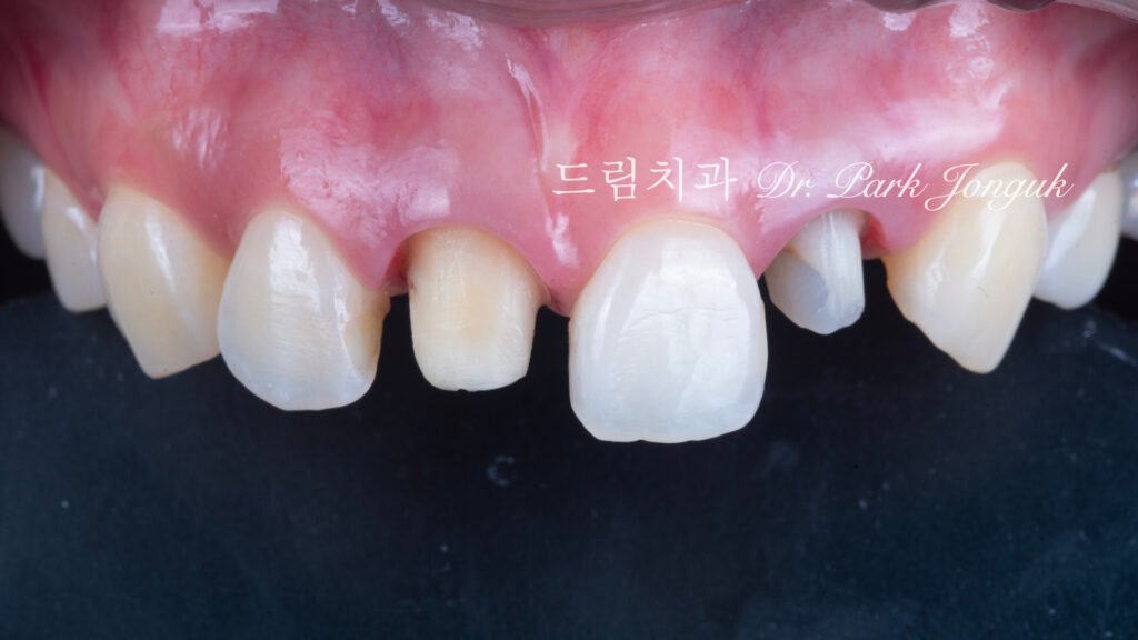 올세라믹 크라운 재시술, All-Ceramic Crown Revision, 라미네이트 재시술, Laminate Revision, 앞니 재치료, Anterior Revision, 실활치 미백, Internal Bleaching, 치은 착색, Gingival Discoloration, 지르코니아 크라운, Zirconia Crown