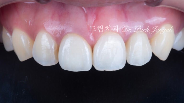 올세라믹 크라운 재시술, All-Ceramic Crown Revision, 라미네이트 재시술, Laminate Revision, 앞니 재치료, Anterior Revision, 실활치 미백, Internal Bleaching, 치은 착색, Gingival Discoloration, 지르코니아 크라운, Zirconia Crown