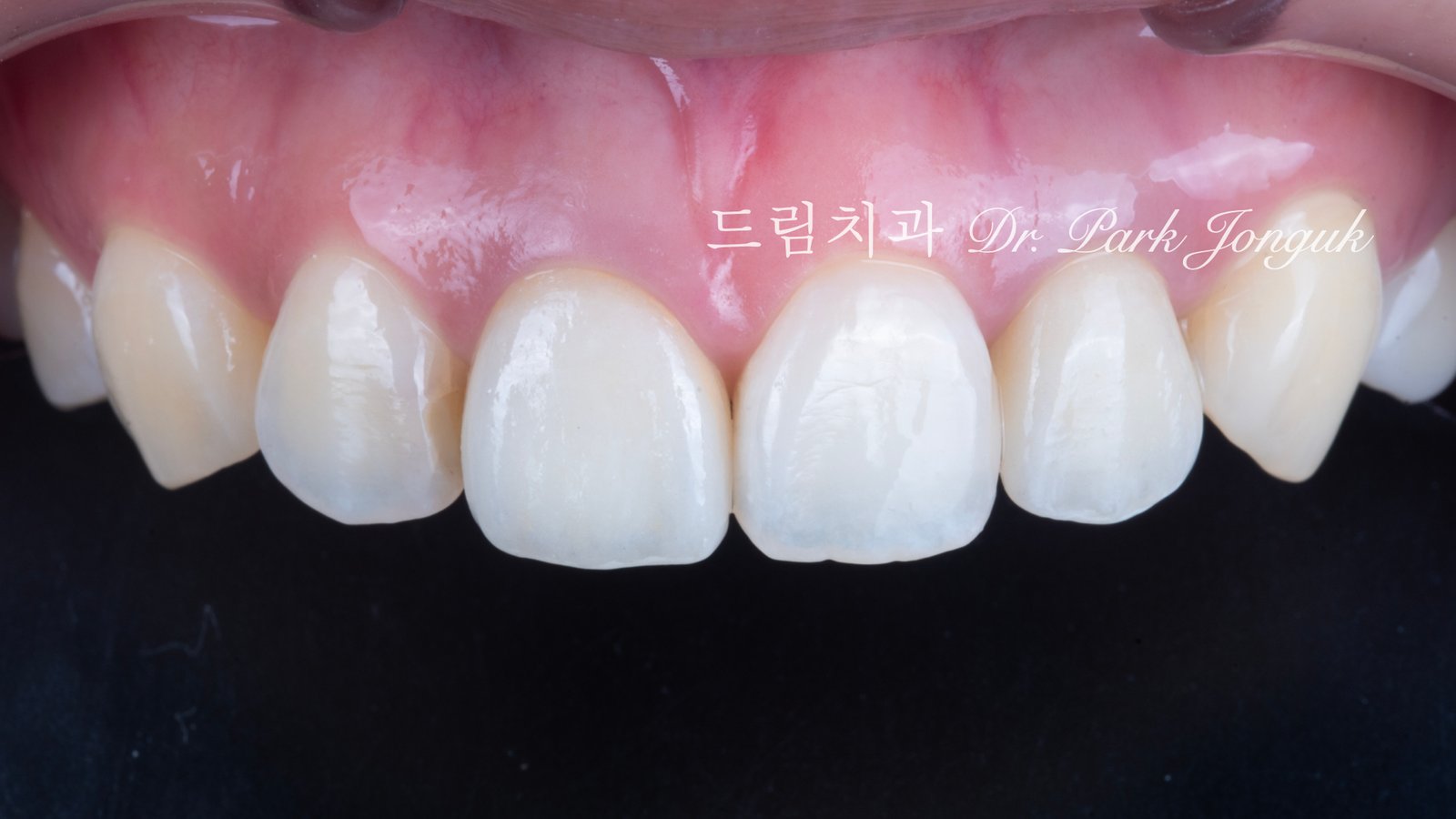올세라믹 크라운 재시술, All-Ceramic Crown Revision, 라미네이트 재시술, Laminate Revision, 앞니 재치료, Anterior Revision, 실활치 미백, Internal Bleaching, 치은 착색, Gingival Discoloration, 지르코니아 크라운, Zirconia Crown