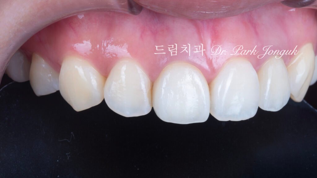 올세라믹 크라운 재시술, All-Ceramic Crown Revision, 라미네이트 재시술, Laminate Revision, 앞니 재치료, Anterior Revision, 실활치 미백, Internal Bleaching, 치은 착색, Gingival Discoloration, 지르코니아 크라운, Zirconia Crown