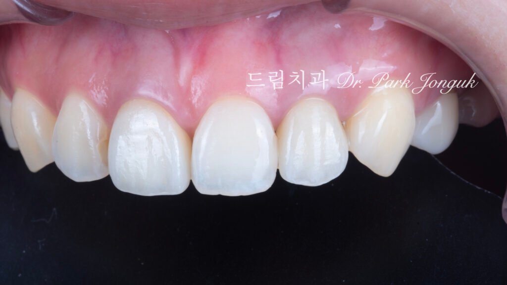 올세라믹 크라운 재시술, All-Ceramic Crown Revision, 라미네이트 재시술, Laminate Revision, 앞니 재치료, Anterior Revision, 실활치 미백, Internal Bleaching, 치은 착색, Gingival Discoloration, 지르코니아 크라운, Zirconia Crown