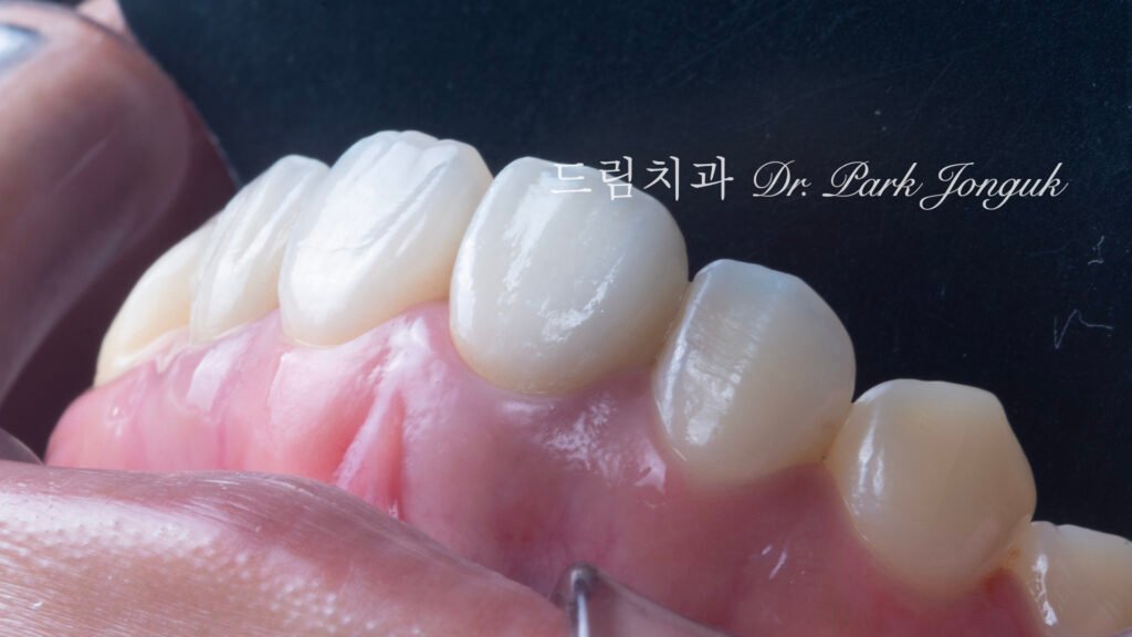 올세라믹 크라운 재시술, All-Ceramic Crown Revision, 라미네이트 재시술, Laminate Revision, 앞니 재치료, Anterior Revision, 실활치 미백, Internal Bleaching, 치은 착색, Gingival Discoloration, 지르코니아 크라운, Zirconia Crown