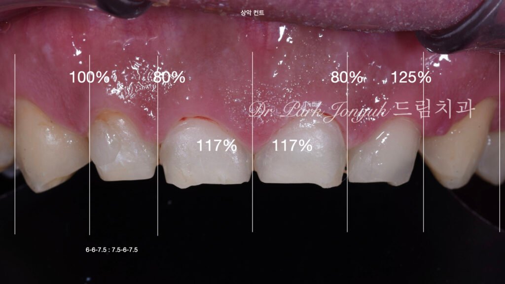 무삭제라미네이트, 치아부식치료, 역류성식도염치아, 교정후라미네이트, 잇몸성형회복, 압구정드림치과, 박종욱원장, 보존과전문의, 앞니심미보철, 최소삭제라미네이트, 디지털왁스업, 치아침식복원