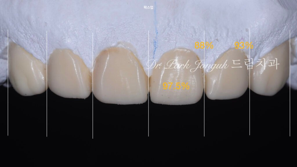 무삭제라미네이트, 치아부식치료, 역류성식도염치아, 교정후라미네이트, 잇몸성형회복, 압구정드림치과, 박종욱원장, 보존과전문의, 앞니심미보철, 최소삭제라미네이트, 디지털왁스업, 치아침식복원