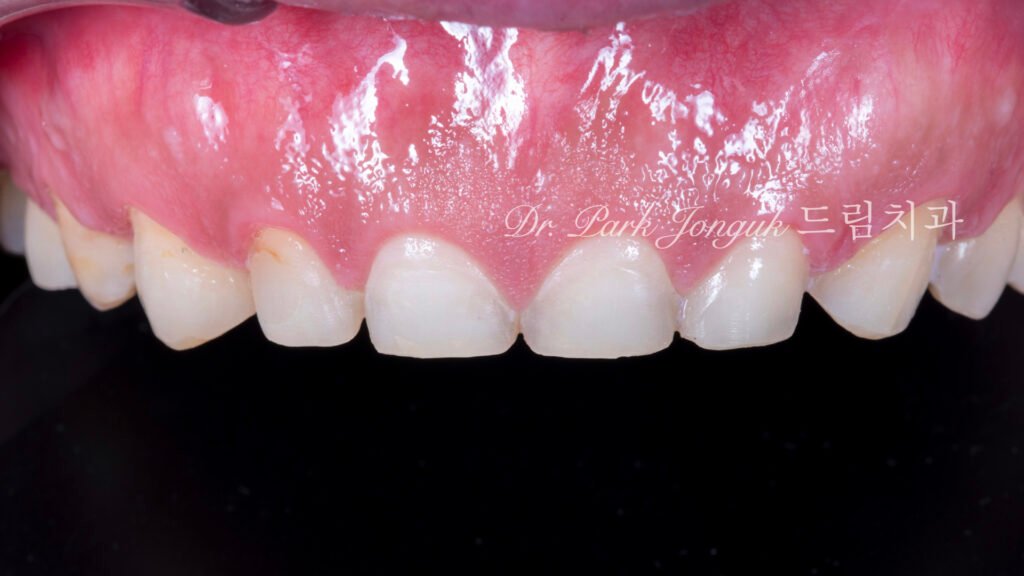 무삭제라미네이트, 치아부식치료, 역류성식도염치아, 교정후라미네이트, 잇몸성형회복, 압구정드림치과, 박종욱원장, 보존과전문의, 앞니심미보철, 최소삭제라미네이트, 디지털왁스업, 치아침식복원