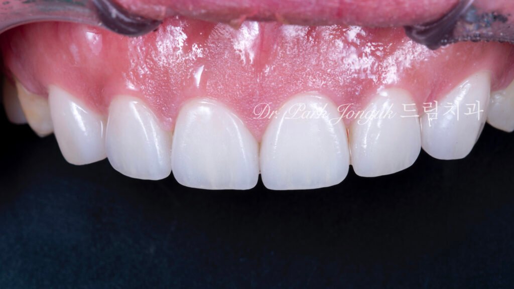 무삭제라미네이트, 치아부식치료, 역류성식도염치아, 교정후라미네이트, 잇몸성형회복, 압구정드림치과, 박종욱원장, 보존과전문의, 앞니심미보철, 최소삭제라미네이트, 디지털왁스업, 치아침식복원