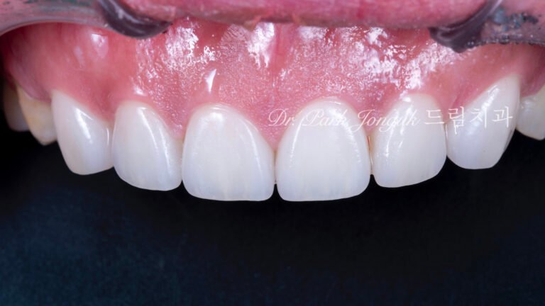 무삭제라미네이트, 치아부식치료, 역류성식도염치아, 교정후라미네이트, 잇몸성형회복, 압구정드림치과, 박종욱원장, 보존과전문의, 앞니심미보철, 최소삭제라미네이트, 디지털왁스업, 치아침식복원