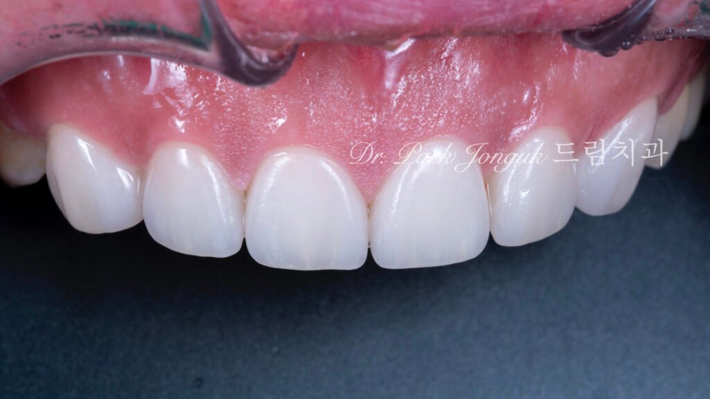 무삭제라미네이트, 치아부식치료, 역류성식도염치아, 교정후라미네이트, 잇몸성형회복, 압구정드림치과, 박종욱원장, 보존과전문의, 앞니심미보철, 최소삭제라미네이트, 디지털왁스업, 치아침식복원