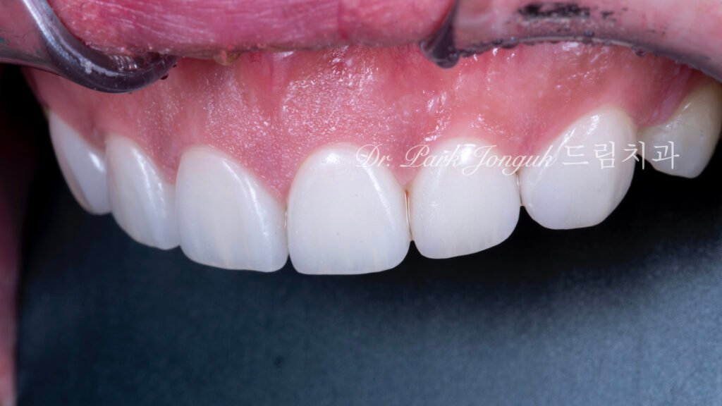 무삭제라미네이트, 치아부식치료, 역류성식도염치아, 교정후라미네이트, 잇몸성형회복, 압구정드림치과, 박종욱원장, 보존과전문의, 앞니심미보철, 최소삭제라미네이트, 디지털왁스업, 치아침식복원