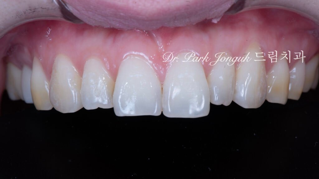 왜소치라미네이트, 여성스러운라미네이트, 앞니라미네이트, PegLateral, 최소삭제라미네이트, 박종욱원장, 압구정드림치과, 보존과전문의, 심미보철진단, 라미네이트잘하는곳, 치아디자인, 핸드메이드보철