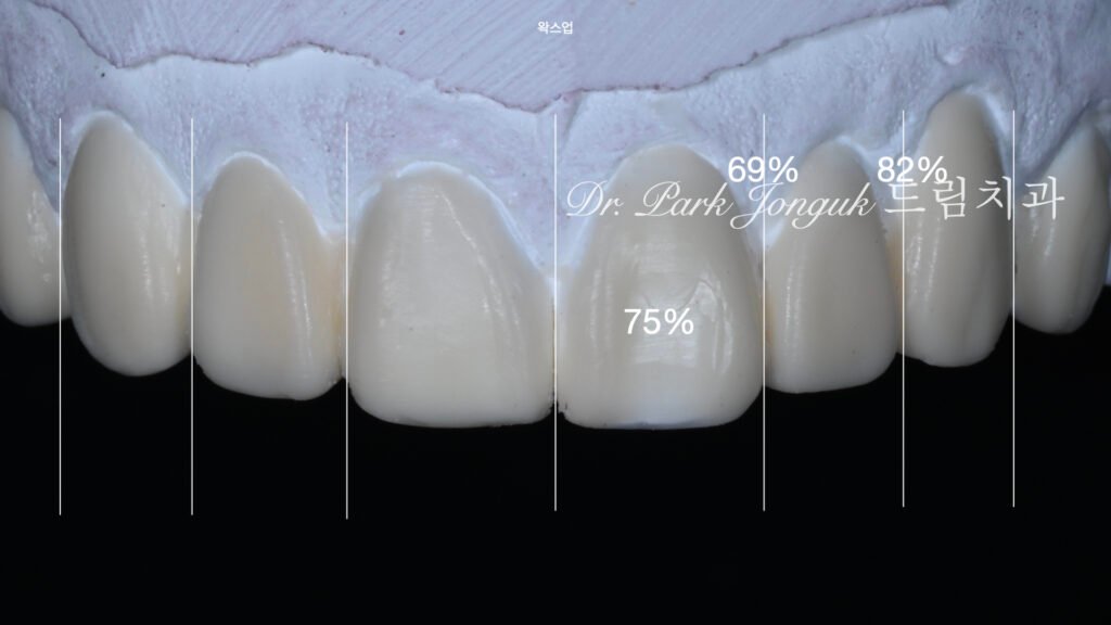 왜소치라미네이트, 여성스러운라미네이트, 앞니라미네이트, PegLateral, 최소삭제라미네이트, 박종욱원장, 압구정드림치과, 보존과전문의, 심미보철진단, 라미네이트잘하는곳, 치아디자인, 핸드메이드보철