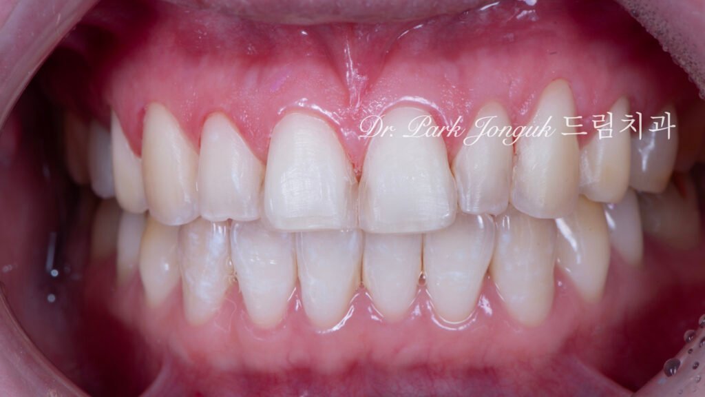 왜소치라미네이트, 여성스러운라미네이트, 앞니라미네이트, PegLateral, 최소삭제라미네이트, 박종욱원장, 압구정드림치과, 보존과전문의, 심미보철진단, 라미네이트잘하는곳, 치아디자인, 핸드메이드보철