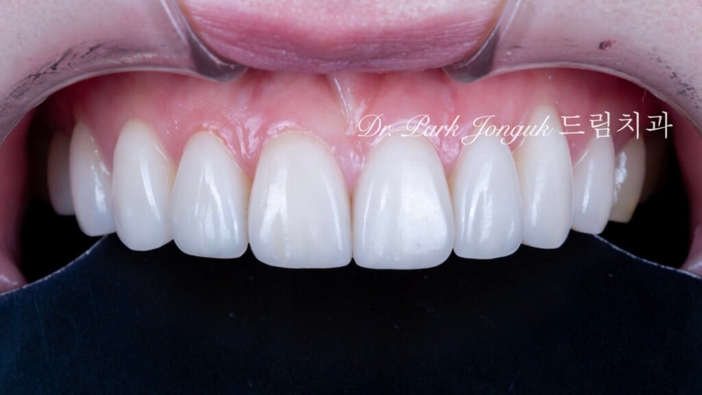 왜소치라미네이트, 여성스러운라미네이트, 앞니라미네이트, PegLateral, 최소삭제라미네이트, 박종욱원장, 압구정드림치과, 보존과전문의, 심미보철진단, 라미네이트잘하는곳, 치아디자인, 핸드메이드보철